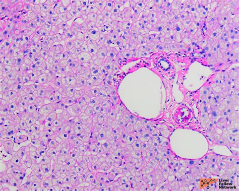 Liver Biopsy Interpretation Special Stains AASLD