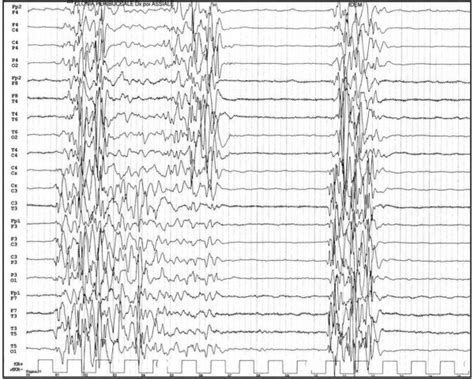 Burst suppression eeg - colorslasem