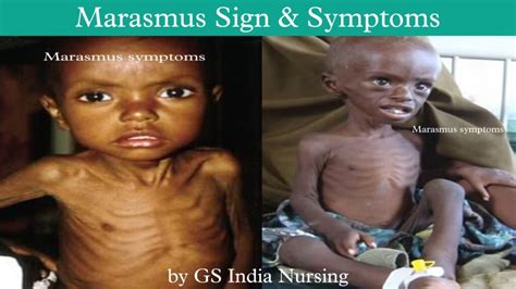 Marasmus Disease Pem Causes Sign And Symptoms Diagnosis Prevention And Treatments — Gs India