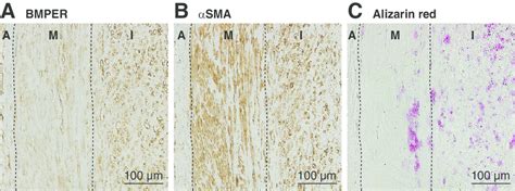 Expression Of BMPER In Human Atherosclerotic Coronary Artery Specimens