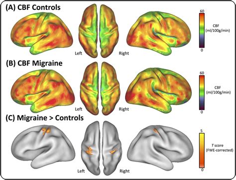 Distribution Of Regional Cerebral Blood Flow Rcbf The Maps