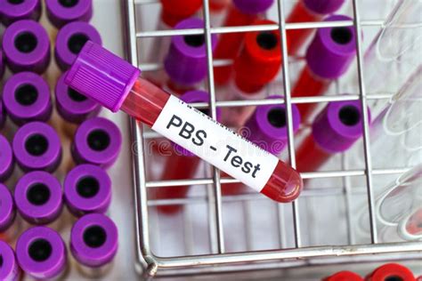 PBS Test To Look For Abnormalities From Blood Stock Photo Image Of