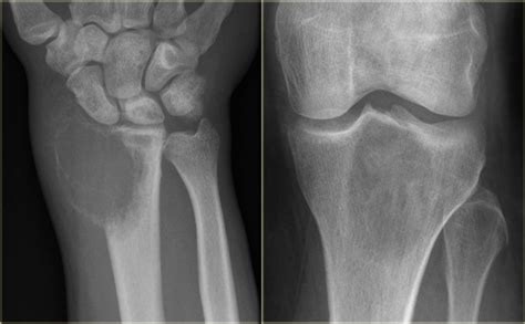 The Radiology Assistant Bone Tumor Osteolytic Tumors And Tumor Like