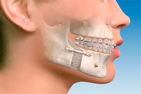 Cirugía maxilofacial todo lo que necesitas saber Dr Samir cirujano