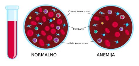 Anemija Simptomi Dijagnostika I Lečenje Sve što Treba Da Znate O