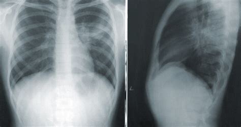 PleurX Drainage Catheter: What to Expect From Your PleurX Placement Procedure? - Health Thoroughfare