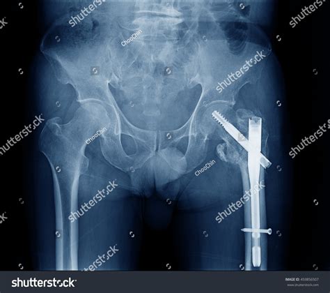 Xray Image Left Side Human Hip Stock Photo 459856507 | Shutterstock