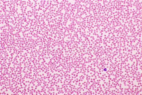 Red Blood Cells in Blood Smear Stock Photo - Image of hematopoiesis ...