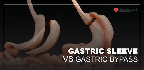 Gastric Sleeve Vs Bypass Surgery ClinicExpert