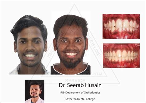 SMILE MAKEOVER AT SAVEETHA DENTAL COLLEGE — orthodontics - SDC