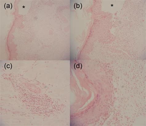 Punch Skin Biopsy Of The Erythematous Papulosquamous Lesions Located On