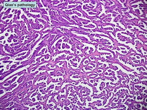 Qiao S Pathology Papillary Renal Cell Carcinoma Microscop Flickr