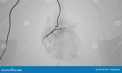 Catheter As Tool for Coronary Angiography Stock Illustration ...