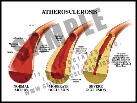 Atherosclerosis S A Medical Graphics