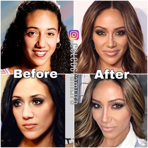 Melissa Gorga Before Plastic Surgery