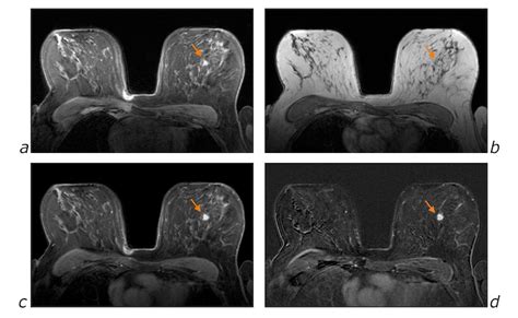 Gadolinium Mri