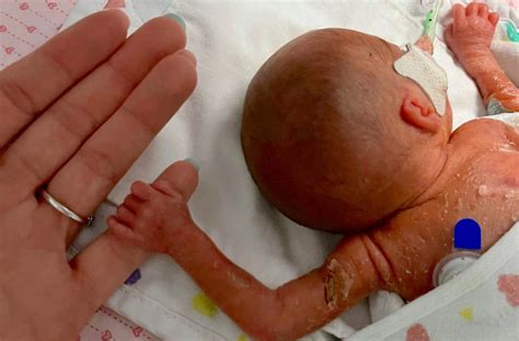 A Baby Born Weighing 1 18 Lb Has Finally Come Home After Spending 4