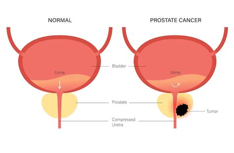 Premium Vector Prostate Cancer Concept