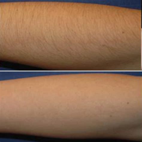 Laser Hair Removal Arms Before After Online Centralcountiesservices Org