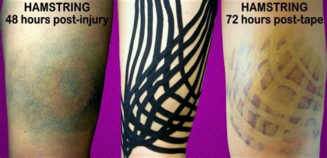 Kinesiology Tape Kinesiology Taping Remedial Massage Kinesiology