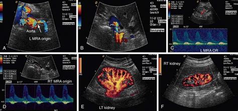 Renal Artery Anatomy Ultrasound