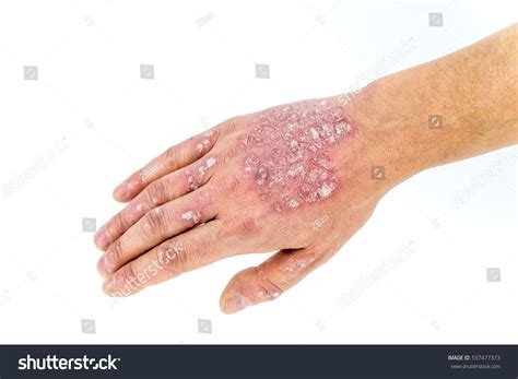 10,467 Hands Psoriasis Images, Stock Photos & Vectors | Shutterstock