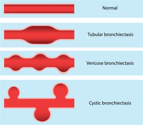 Causes, Symptoms, Diagnosis and treatment of bronchiectasis | Holistic ...