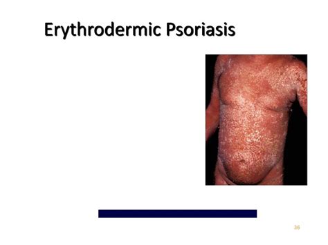 psoriasis powerpoint    id