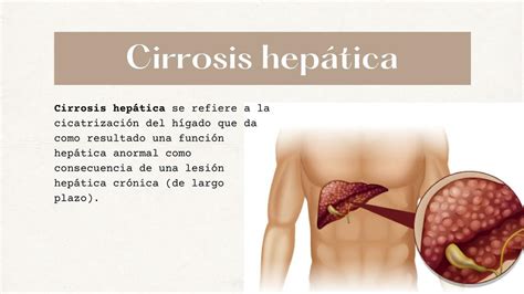 Cirrosis Hep Tica Celeste Ortega M Udocz