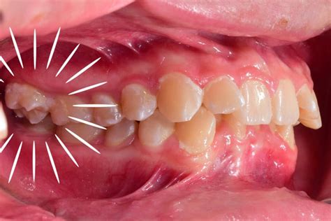 Problemas De Mordida Sonríe 123 Ortodoncia And Estética Guayaquil