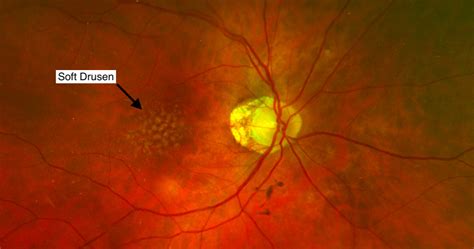 Macular Degeneration Treatment London