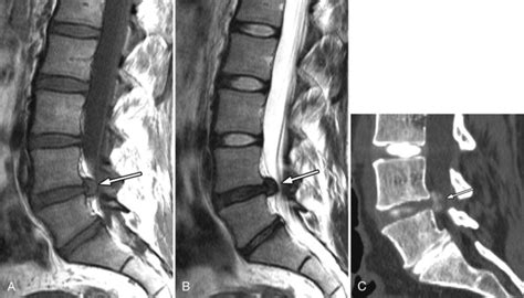 Disc Herniation—lumbar Radiology Key