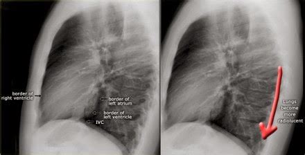 Chest Medicine Made Easy Dr Deepu Chest X Ray Part Normal Anatomy