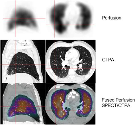 Vq Scanning Using Spect And Spectct Journal Of Nuclear Medicine