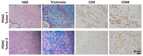 Human PDAC Tumors Display Pronounced Desmoplasia Macrophages But Lack