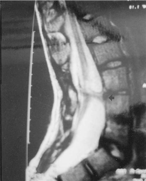 Figure 3 From Faun Tail With Aplasia Cutis Congenita And