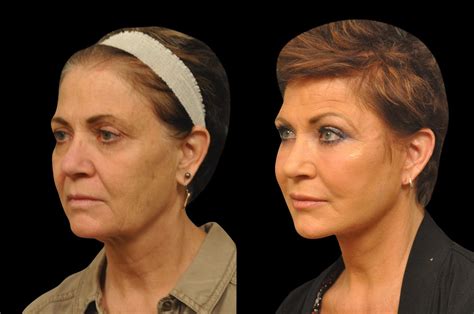 Patient 352439 Changes Rapid Lift Before And After Photos Changes