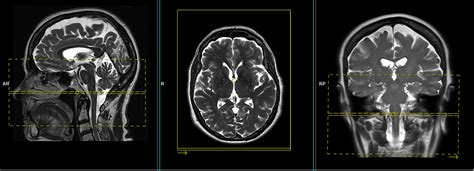 Temporomandibular Joints Tmjs Mri Planning And Protocols