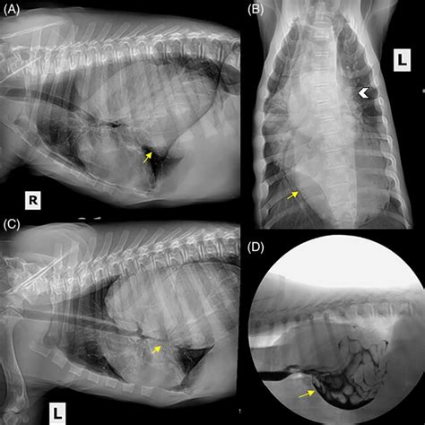 Treatment Algorithm For Esophageal Achalasia Lhm Laparoscopic Heller