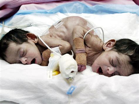 Conjoined Twins Amazing Photos Graphic Images Photo