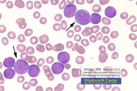 Blasts From Acute Lymphocytic Leukemia All Patient Medical Laboratories