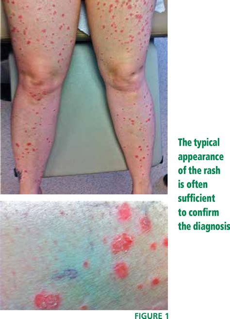 Figure 1 From A Rash After Streptococcal Infection Semantic Scholar