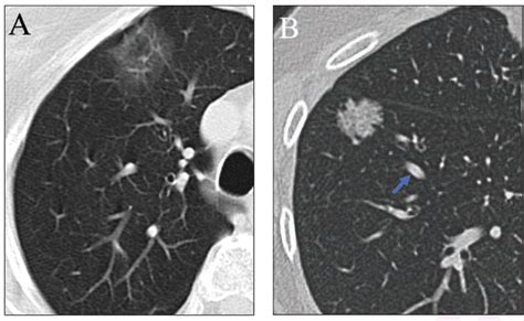 What Emerging CT Research Reveals About Pure Ground Glass Nodules