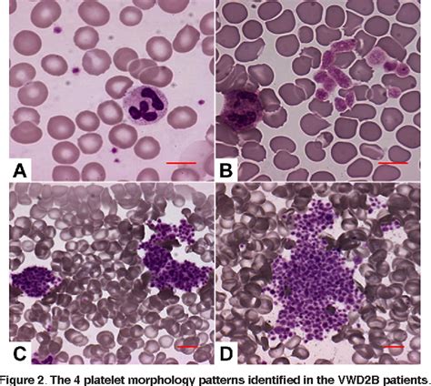 Von Willebrand Disease Type 2b Semantic Scholar