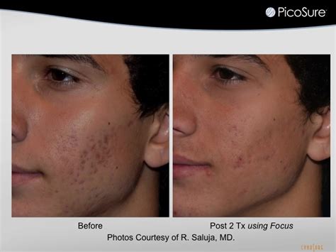 Treat Your Acne Scars With Our PicoSure Laser - The Aesthetic Laser ...