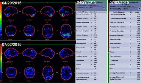 Neurological Lyme Disease Treatment | Sponaugle Wellness Institute