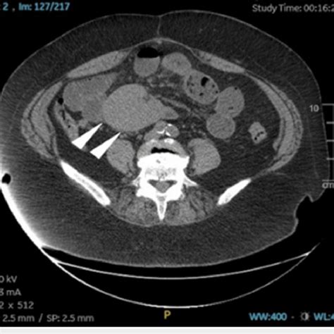 Ct Of The Abdomen And Pelvis Without Contrast Supine Position Axial Download Scientific