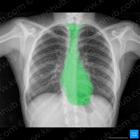 How To Read A Normal Chest X Ray A Step By Step Approach