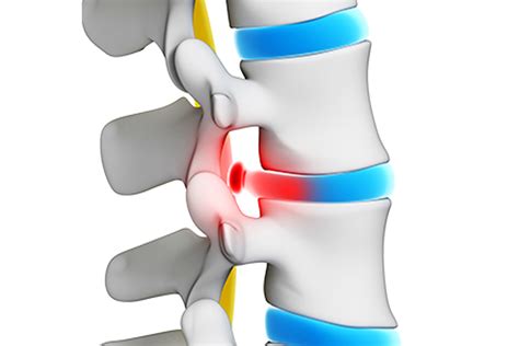 Herniated Or Bulging Discs Spinal Rehab Clinics