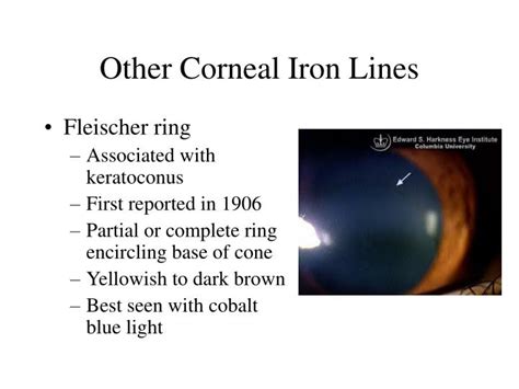 Ppt Corneal Iron Ring After Hyperopic Lasik Powerpoint Presentation